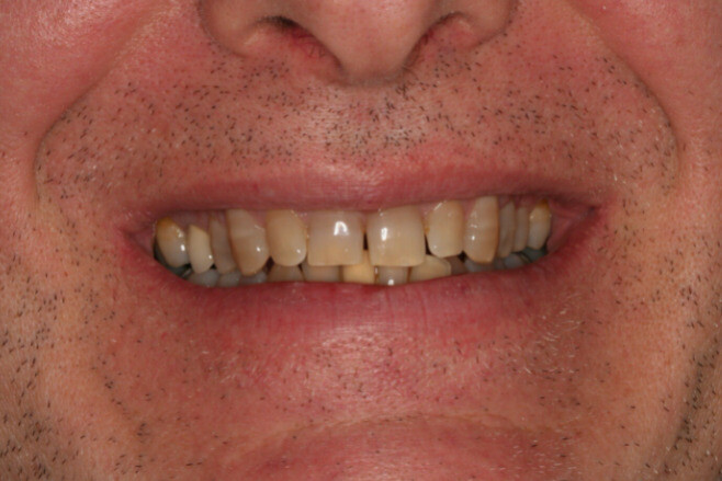 Tetracycline có thể gây tác dụng phụ làm đổi màu răng ở người lớn và trẻ em (nguồn ảnh: carnazzadental.com)
