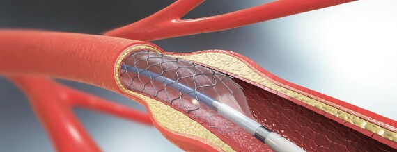 Nong và đặt stent mạch vành. Nguồn ảnh: hopkinsmedicine.org