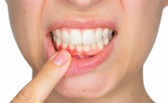 I have bleeding gums. What can I do? - Clínica Blasi