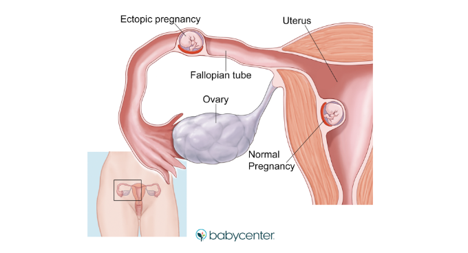 DiagramDescription automatically generatedHình ảnh trứng đã thụ tinh làm tổ ở ống dẫn trứng (nguồn: Babycenter)