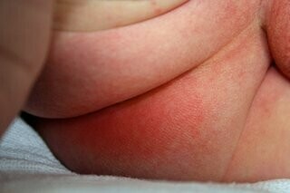 Phát ban đỏ trên mông của em bé.  Nguồn ảnh: www.nhs.uk