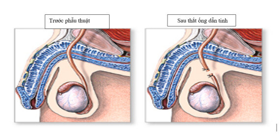 Thắt ống dẫn tinh chỉ can thiệp tới đường dẫn của tinh trùng, không ảnh hưởng tới hoạt động tình dục. Nguồn ảnh: https://www.trivalleyurology.com/ 