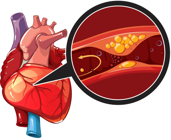 Bệnh động mạch vành. Nguồn ảnh: thekeyholeheartclinic.com