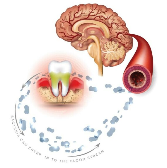 Người bị viêm nha chu có nguy cơ đột quỵ cao hơn. Nguồn ảnh: https://specialty.mims.com/