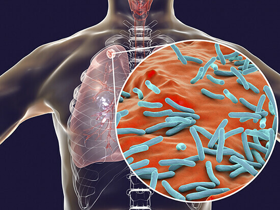 Vi khuẩn lao gây bệnh phổi cho người, nguồn ảnh uab.edu