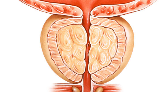 Ung thư tiền liệt tuyến. Nguồn ảnh: kasraeianurology