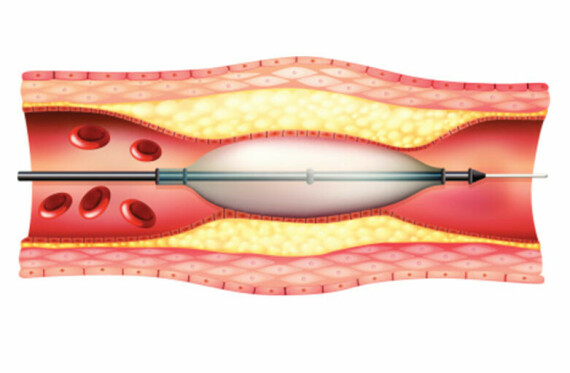 Nong mạch vành. Nguồn ảnh: lamvascular.com