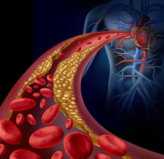 Tăng LDL cholesterol máu làm tăng nguy cơ gây xơ vữa động mạch. Nguồn ảnh: https://www.integrativehealthcare.org/