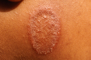 Ban da màu nâu đỏ có vảy hình bầu dục trên má trẻ do bệnh hắc lào trên nền da hơi nâu.Nguồn ảnh: www.nhs.uk