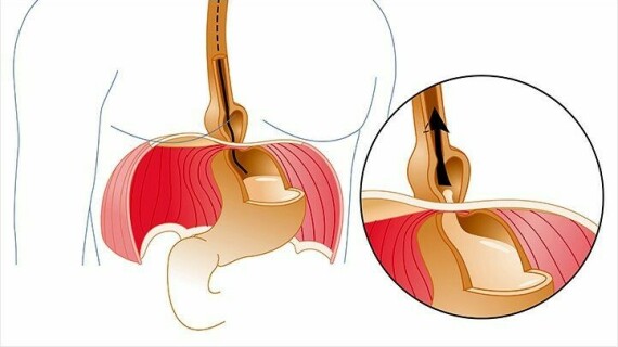 Thoát vị khe hoành xảy ra khi mô cơ quanh lỗ khe hoành suy yếu khiến một phần dạ dày đi vào lồng ngực. Nguồn: eveydayhealth.comThoát vị khe hoành xảy ra khi mô cơ quanh lỗ khe hoành suy yếu khiến một phần dạ dày đi vào lồng ngực. Nguồn: eveydayhealth.com