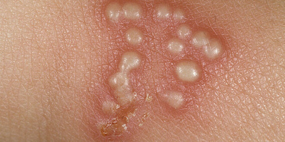 Tổn thương herpes simplex mọc thành cụm.  Nguồn ảnh: thedermspecs.com