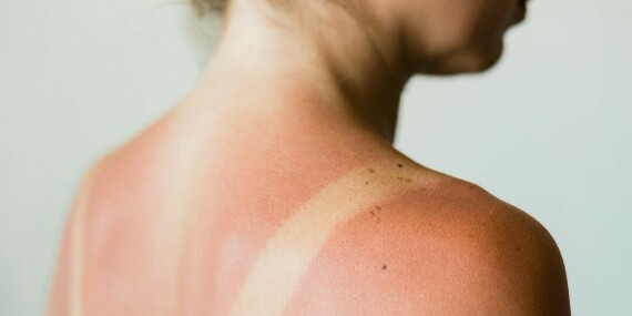 17 Sunburn Cures for Instant Relief - How to Get Rid of Sunburn Fast