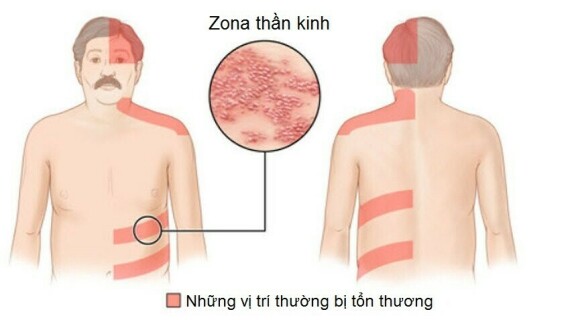 Nguồn ảnh: tudienbenhhoc.com