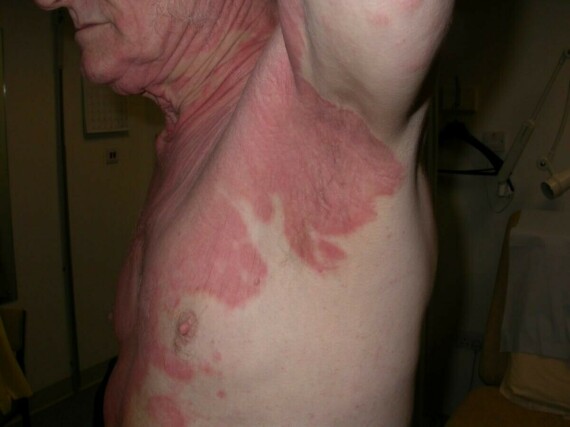 Trên thân người, viêm da tiết bã thường xuất hiện xung quanh các nếp gấp da. Nguồn: pcds.org.uk