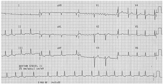 ECG rung nhĩ với các nhịp tim không đều