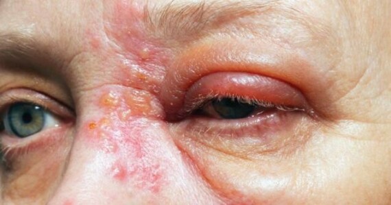 Bệnh zona thần kinh ở mắt là một biến chứng nghiêm trọng có thể gây ra các thương tổn vĩnh viễn. Nguồn ảnh: webmd.com   