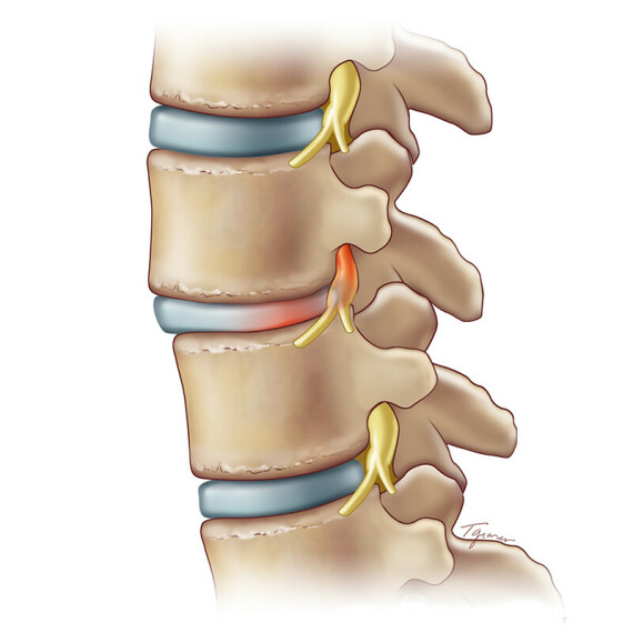 Tổn thương thân đốt sống, đĩa đệm, dây thần kinh cột sống do lao. Nguồn: Rxharun