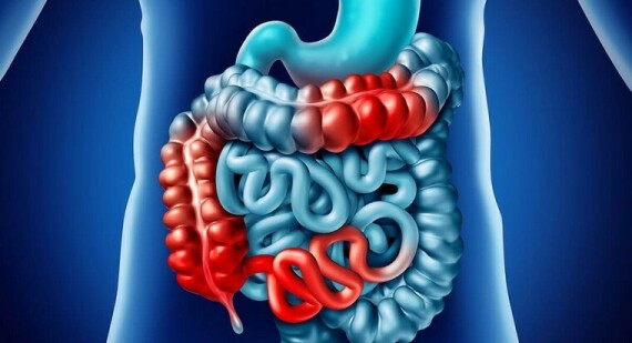 Bệnh crohn có thể gây rò tiêu hoá tự phát, nguồn ảnh worldakkam.com