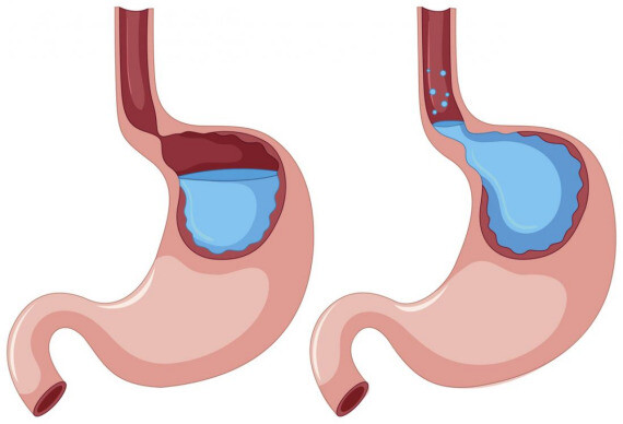 Trào ngược axit dạ dày ( nguồn ảnh: https://www.medicalnewstoday.com/)