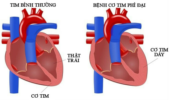 Cơ tim phì đại. Nguồn ảnh: news-medical.net