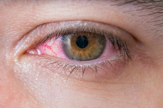 Có 3 nguyên nhân chính dẫn đến bệnh đau mắt đỏ. (Nguồn ảnh medicalnewstoday.com)