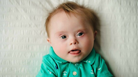Trẻ mắc hội chứng Down có biểu hiện mặt bẹt,đầu và tai nhỏ,cổ ngắn,lưỡi phồng,mắt xếch lên trên (nguồn ảnh: https://www.medicine.net/) 