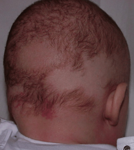 Trẻ em dưới 5 tuổi thường không bị ảnh hưởng nhiều về mặt tinh thần do chứng rụng tóc. (nguồn: researchgate.net)