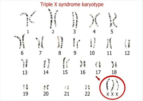 Bất thường bộ nhiễm sắc thể(NST) ở người mắc hội chứng siêu nữ, mũi tên đỏ(nguồn ảnh: https://www. news-medical.net/)