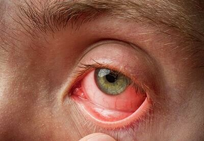 Đau mắt đỏ (Nguồn ảnh my.clevelandclinic.org)