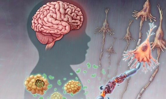 Bệnh Tay–Sachs là một rối loạn di truyền dẫn đến sự phá hủy các tế bào thần kinh trong não và tủy sống 