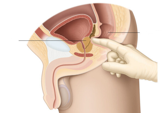 Thăm khám trực tràng. Nguồn ảnh: patients.uroweb