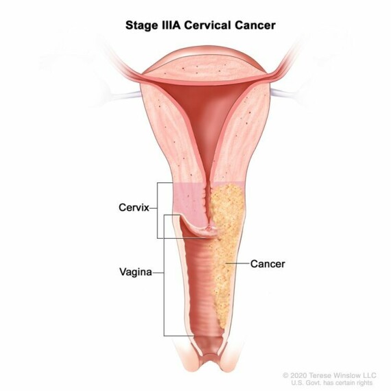 Giai đoạn IIIA ung thư cổ tử cung. Ung thư đã lan đến 1/3 dưới của âm đạo nhưng chưa lan đến thành chậu.