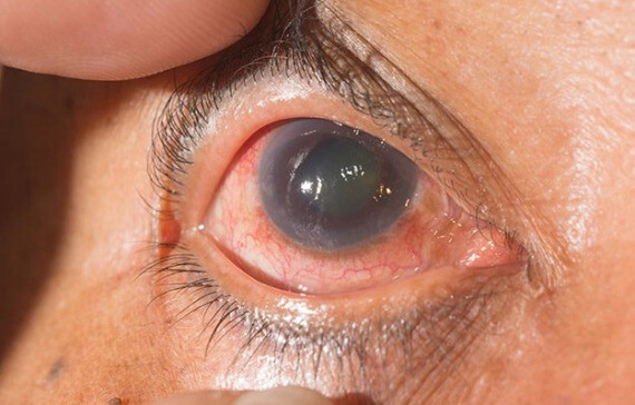 Thủy dich bị tích tụ lại trong mắt sẽ làm tăng áp suất trong mắt, gây ra bệnh tăng nhãn áp.(nguồn: europeaneyecenter.com)