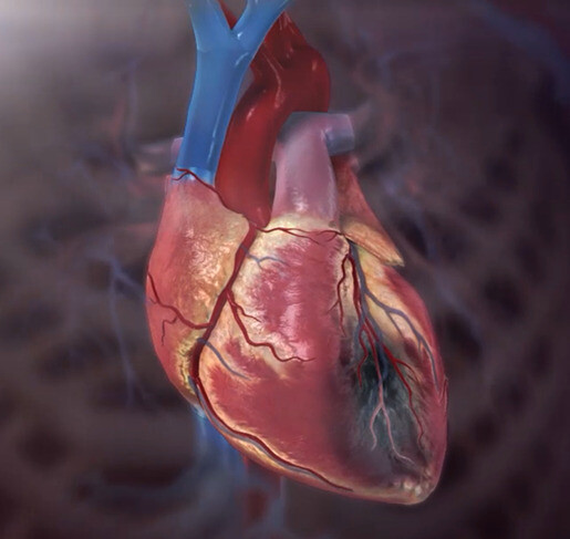 Nhồi máu cơ tim là một trong những biến chứng nguy hiểm của bệnh thiếu máu cơ tim. Nguồn ảnh: visiblebody.com