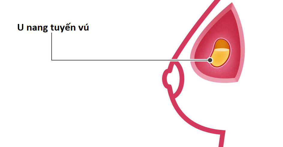 U nang tuyến vú có thể là nguyên nhân gây đau vú (Nguồn ảnh: National Breast Cancer Foundation)