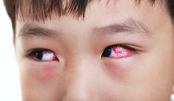 Đau mắt đỏ ở trẻ nhỏ có thể gây ra biến chứng nguy hiểm nếu không được điều trị đúng đắn