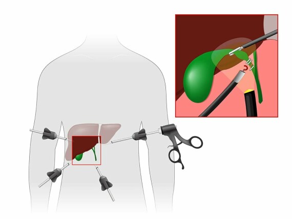 Phẫu thuật cắt túi mật nội soi. Nguồn ảnh: Drmjaber.com.au