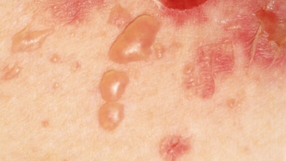 Bọng nước trong bệnh Pemphigus. Nguồn ảnh: tuticare.com