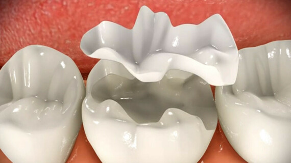 Inlay Onlay | Dentist Kusadasi | Cosmetic Dentistry TurkeyOnlay là loại phục hình không che phủ hết thân răng. Nguồn ảnh: Dentistkusadasi.com