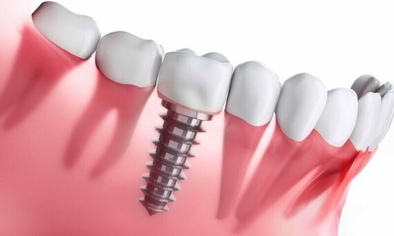Cấy ghép implant không ảnh hưởng đến các răng bên cạnh
