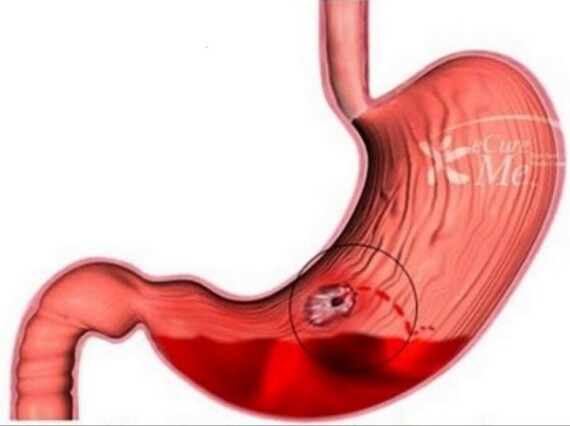 Xuất huyết tiêu hóa nặng là một trong những biến chứng của viêm loét dạ dày tá tràng (nguồn ảnh: https://gastroenterologists.alliedacademies.com/) 