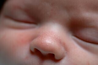 Nhiều đốm mụn trắng trên mũi trẻ.  Nguồn ảnh: www.nhs.uk