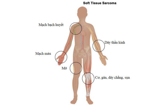 Sarcoma mô mềm hình thành tại các mô mềm của cơ thể, bao gồm cơ, gân, mỡ, mạch máu, mạch bạch huyết, dây thần kinh và mô xung quanh khớp. Nguồn ảnh: Cancer.gov
