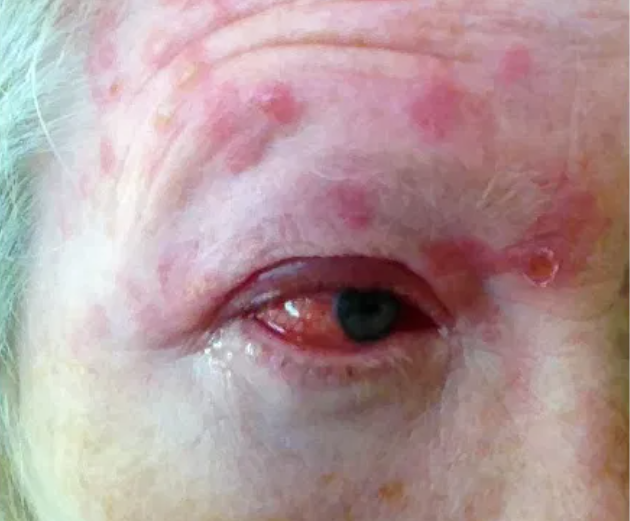 Người lớn tuổi có nguy cơ cao bị bệnh zona ở vùng trán, gần mắt.(nguồn ảnh: Wikimedia Commons)