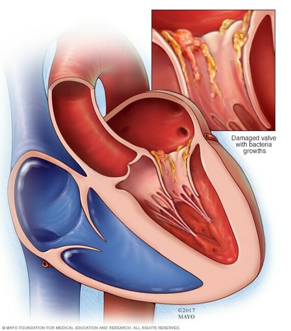 Van 2 lá bị phá hủy trong viêm nội tâm mạc nhiễm khuẩn (nguồn: https://www.mayoclinic.org/)