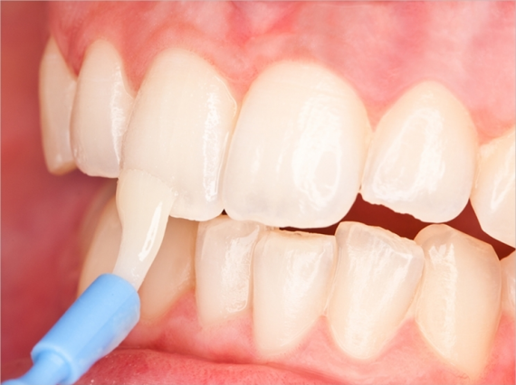 Nha sĩ sẽ bôi dạng gel hoặc dầu bóng (vecni) fluor lên bề mặt răng, thường lưu lại trong một phút.   (nguồn: dentistrytoday.com)