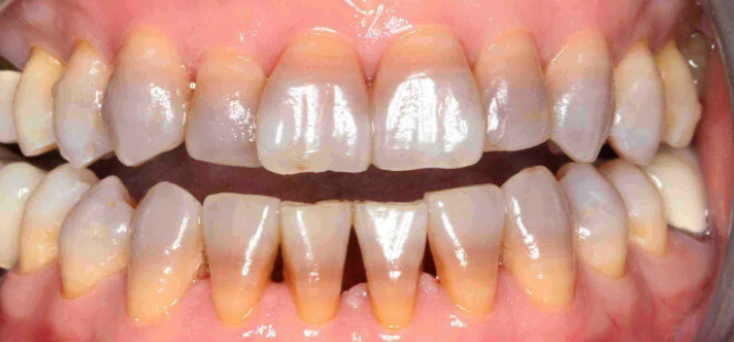 Tác dụng phụ của Tetracycline có thể khiến răng đổi sang màu xám, nâu hoặc vàng (nguồn ảnh: pinterest.com)