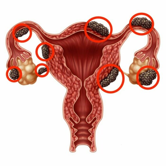 Hình minh họa lạc nội mạc tử cung (những đám màu đen), nguồn: https://www.insider.com