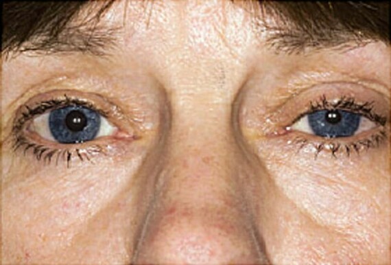 Close up of a person's eyesDescription automatically generated with medium confidenceHội chứng Horner có biểu hiện đồng tử co nhỏ hơn so với bên còn lại   (Nguồn ảnh: https://www.webmd.com)