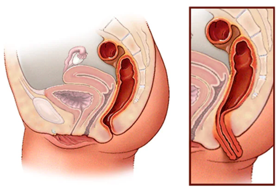 Sa trực tràng xảy ra khi trực tràng (đoạn cuối cùng của ruột già) bị sa xuống khỏi vị trí bình thường trong vùng chậu và thò ra ngoài qua hậu môn. (nguồn: https.mayoclinic.org)
